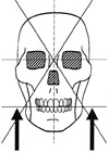 Tête et Visage Asymétriques.