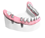 Implant Dentaire
