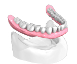 Implant Dentaire