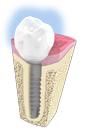 Implant dentaire