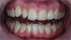 Orthèse dentaire en bouche