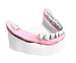 Implant Dentaire