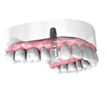 Implant Dentaire Drome